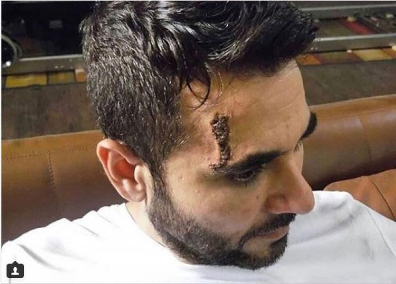 إصابة قوية لأحمد عز في وجهه  Image
