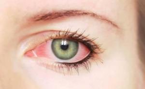 اختراق علمي ..  علاج جديد لمرضى مهددين بالعمى
