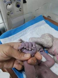 حالة نادرة ..  ولادة طفلة بـ24 إصبعًا (صور)