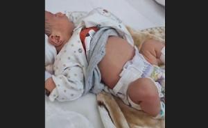 ولادة طفل يحمل توأمه داخل بطنه في تونس 